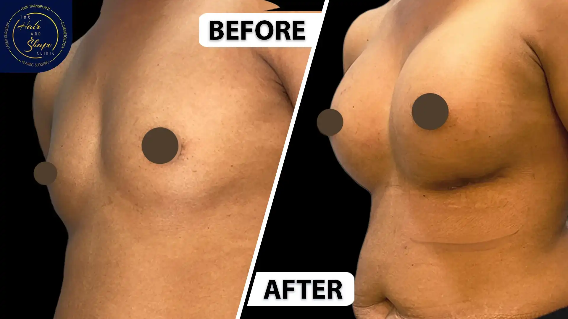 Breast Augmentation result